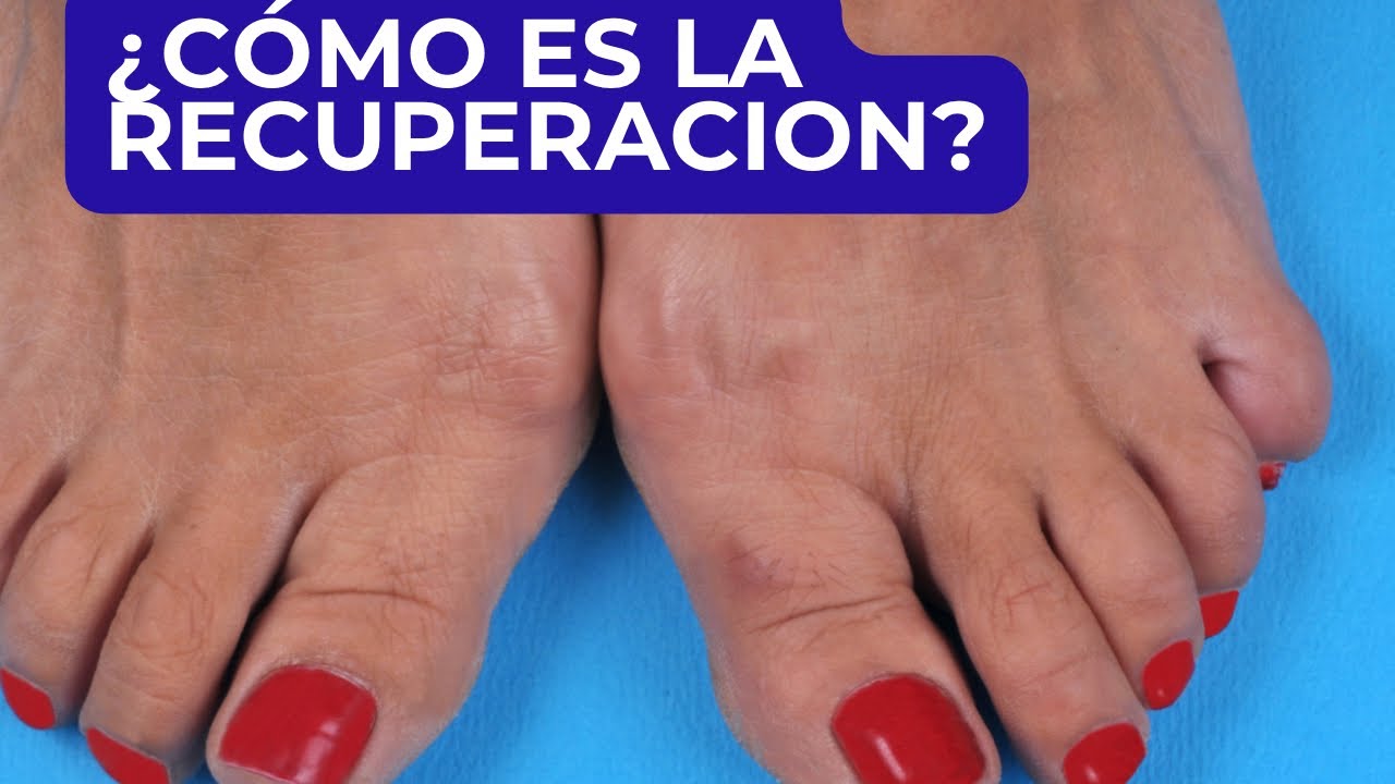 cuando se puede conducir después de una operación de juanetes